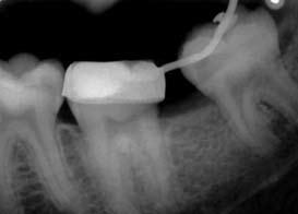 Η εναλλακτική θεραπεία που προτάθηκε ήταν η ανόρθωση του δοντιού μέσω της συσκευής Halterman.