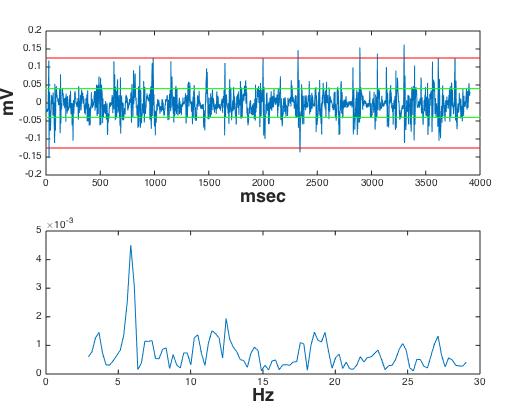 LS 18-19 Δυναμικό μεταξύ 0.04-0.25mV. Μήκος κύκλου <120msec. DF = 5.8 RI = 0.