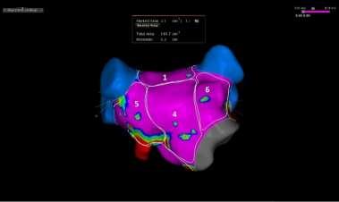 recurrence 5 m post RF B