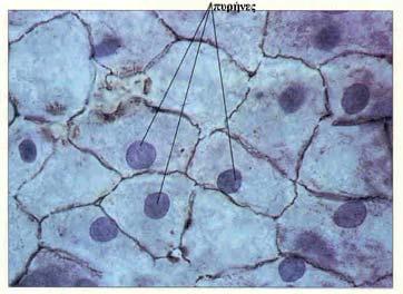 78 Το πλακώδες επιθήλιο, Παρασκευάσματα 70101c, 70115d Τα πλακώδη επιθηλιακά κύτταρα είναι πολύ λεπτά, πλατειά με ακανόνιστο σχήμα.