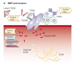 Εικόνα 5: Ρόλος των καλλικρεϊνών στην καρκινική διήθηση Η KLK3 δύναται, έμμεσα, να προάγει την αποδιαφοροποίηση των καρκινικών επιθηλαικών κυττάρων σε μεσεγχυματικού χαρακτήρα κύτταρα