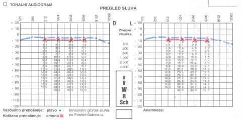 provodljivosti lateralizacije zvuka Audiometar Tonalni audiogram