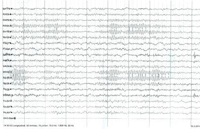 53Hz, A do 300 µv, duboke faze nonrema Gama ritam f preko 30Hz, učenje, intenzivna pažnja SRCE Indikacije za EEG ispitivanje: epilepsija i drugi poremećaji svesti ekspanzivni intrakranijalni procesi