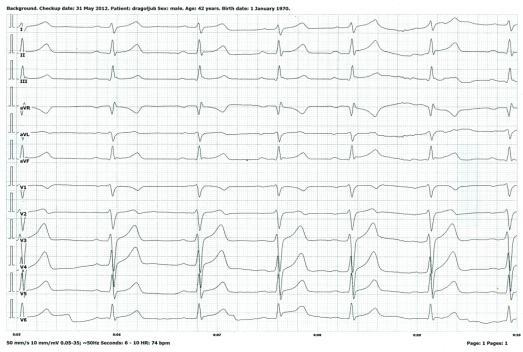 kombinovano avl Leva ruka Desna ruka i leva noga kombinovano avf Leva noga Desna ruka i leva ruka kombinovano Odvodi u horizontalnoj ravni Elektrokardiografija EKG PREKORDIJALNI ODVODI Naziv odvoda V