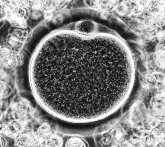 ευτερογενές ωοκύτταρο + 1 ο πολικόσωµάτιο 1 st