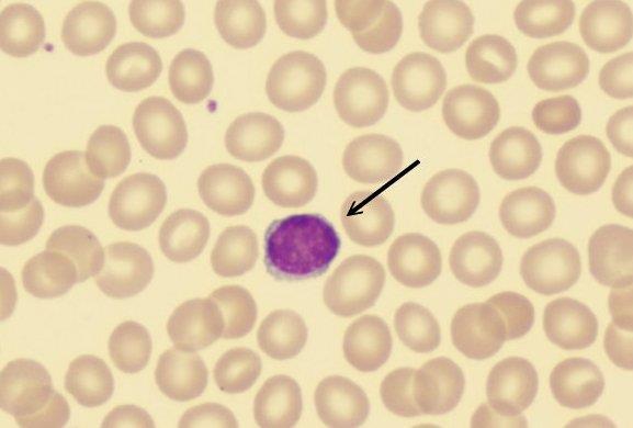 ΛΕΜΦΟΚΥΤΤΑΡΑ (lymphocytes) Εμφάνιση: Τα λεμφοκύτταρα έχουν ένα στρόγγυλο προς οβάλ πυρήνα και το μέγεθός τους μοιάζει περίπου το μέγεθος των ερυθροκυττάρων. Το κυτταρόπλασμα χρωματίζεται γκρι-μπλε.