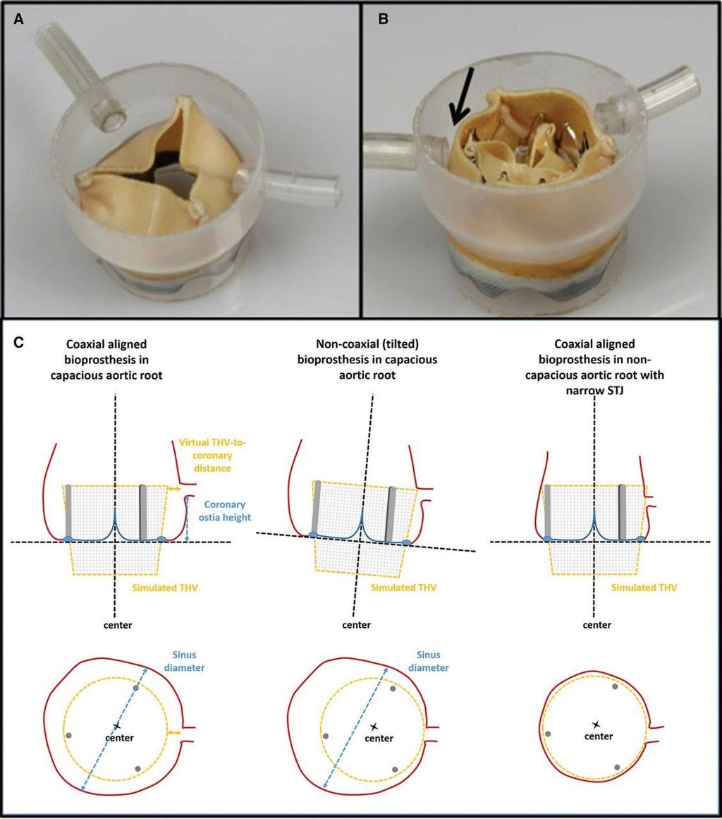 A, A model of an aortic root with a surgical bioprosthesis