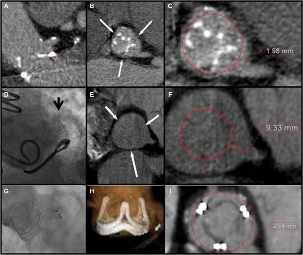 Contrast-enhanced ECG-gated computed tomography for the assessment of coronary occlusion risk. Failed Mitroflow 23 bioprosthesis. Coronary to ring distance short.
