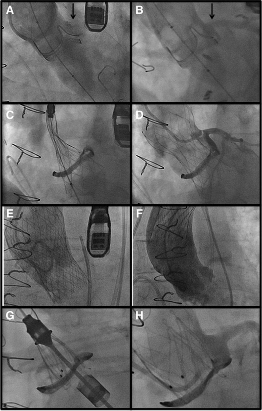A and B, Aortic balloon inflation used for the assessment of coronary occlusion risk. Coronary flow obstruction, with a protective coronary guidewire in place (A) and unimpaired flow (B).