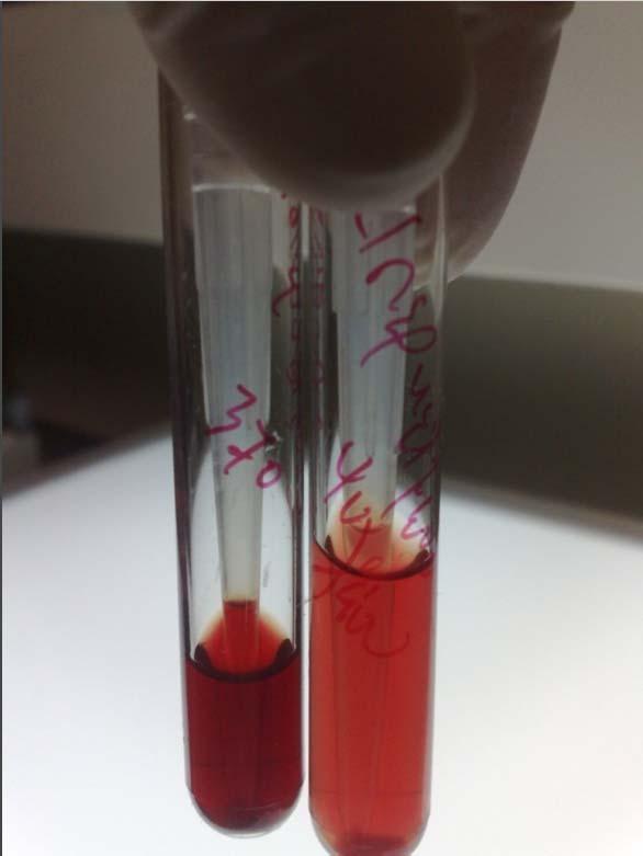 ράση Αιμολυσίνης στους 4-37 ο C Τα αυτόλογα ερυθρά αιμολύονταν in vitro και στους 4 ο και στους 37 ο C.
