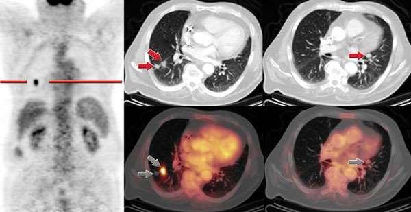 PET-CT μονήρους πνευμονικού όζου Άνδρας 67 ετών με 3 πνευμονικά οζίδια, ένα εκ των οποίων υπερμεταβολικό στο PET.