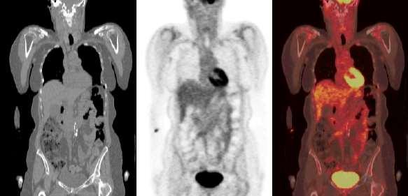 Τεχνική PET-CT Η σύντηξη των εικόνων CT (χωρική ανάλυση <1mm) με τις εικόνες PET (χωρική ανάλυση