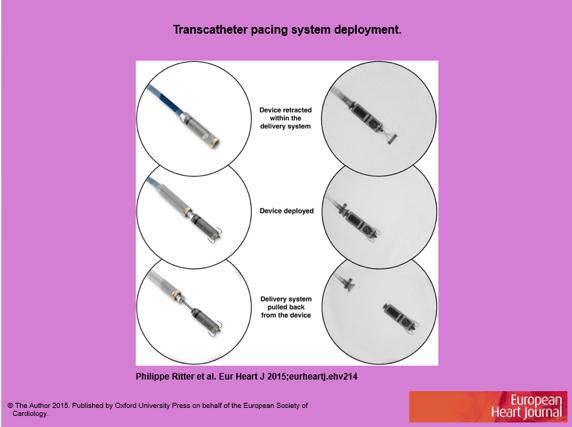 Transcatheter pacing system deployment. Step 1, upper panel: the device is fully retracted within the delivery system. The distal end of the catheter is placed at the targeted site of the RV.