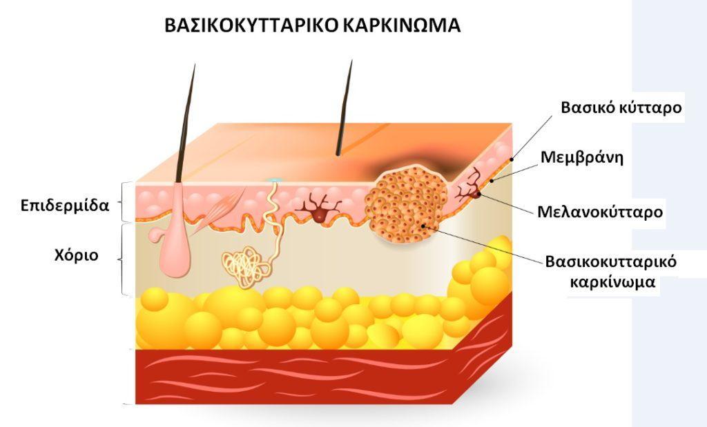 Καρκίνοι δζρματοσ NMSC: μεκοτρεξάτθ, anti-tnf ι vedolizumab Βαςικοκυτταρικό καρκίνωμα δζρματοσ: >50 ετϊν,