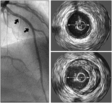 The IVUS technique can detect angiographically silent atheroma Angiogram No evidence of disease IVUS Little