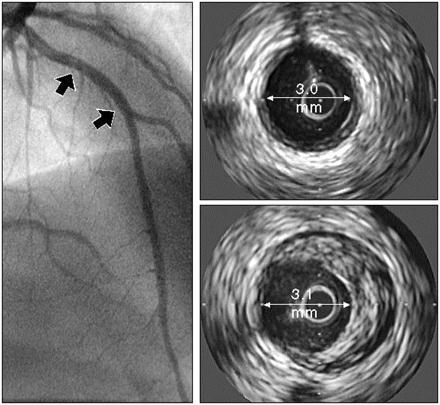 The IVUS technique can detect angiographically silent atheroma Angiogram No evidence of disease IVUS Little