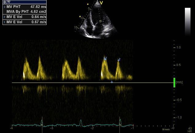 Dt= 161ms