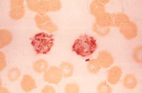 Λευχαιμία εκ τριχωτών κυττάρων Τα τριχωτά