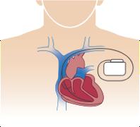 Η επίδραση της θεραπείας με σακουμπιτρίλη / βαλσαρτάνη στον αιφνίδιο καρδιακό θάνατο δεν επηρεάστηκε από την παρουσία εμφυτεύσιμης συσκευής απινιδωτή Αιφνίδιος Καρδιακός Λόγος κινδύνου,