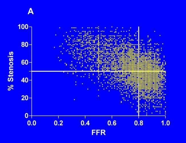 FFR and QCA r =-0.51, p<0.