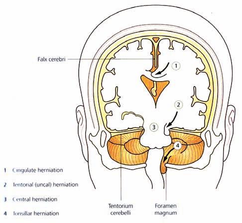 Εικόνα 5. Τύποι εγκολεασμού. εγκεφαλική βλάβη, λόγω της μεγάλης σημασίας που έχει η ταχύτητα με την οποία πρέπει να γίνονται οι παρεμβάσεις μας, αρκεί μία αδρή νευρολογική εξέταση.