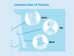 επίσης ότι μετά τα 50 έτη ζωής μία στις τρεις γυναίκες και ένας στους πέντε άνδρες θα υποστούν οστεοπορωτικό κάταγμα [26-28]. Εικόνα 1.7 Σκελετικές περιοχές συνήθων οστεοπορωτικών καταγμάτων (www.