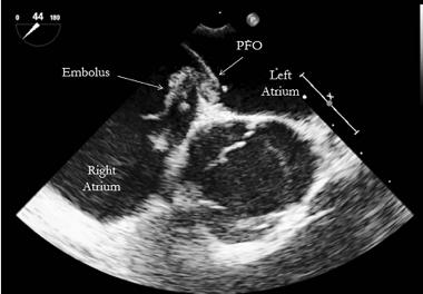 PFO and PE