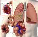 ΠΝΕΥΜΟΝΙΚΟ ΕΜΦΥΣΗΜΑ Πνευμονικό εμφύσημα είναι μια αναστρέψιμη κατάσταση, που χαρακτηρίζεται από καταστροφή του πνευμονικού ιστού και από δομικές μεταβολές μέσα στον πνεύμονα, όπως (α) υπερδιάταση των