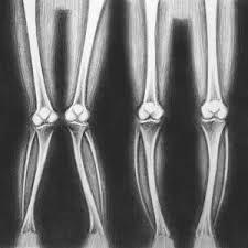 ΡΑΙΒΟ ΒΛΑΙΣΟ ΓΟΝΑΤΟ Ραιβό λέγεται το γόνατο όταν η κνήμη σχηματίζει με το μηρό γωνία ανοικτή προς τα έσω έτσι ώστε όταν τα έσω σφυρά έρχονται σε επαφή, τα γόνατα απέχουν μεταξύ τους.