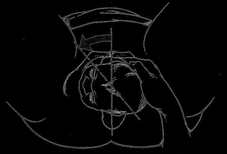 Χειρισμός Rubin Τοποθέτηση των δακτύλων του μαιευτήρα στην οπίσθια επιφάνεια του περισσότερο