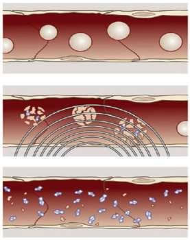 Nature 2003) Ανάγκη για εξειδικευμένη σχεδίαση Contrast Agents, ώστε να επιτευχθεί ελεγχόμενη ταλάντωση ή/και καταστροφή τους Ανάγκη για ανάπτυξη μοντέλων που θα καλύπτουν ευρύτερο φάσμα της