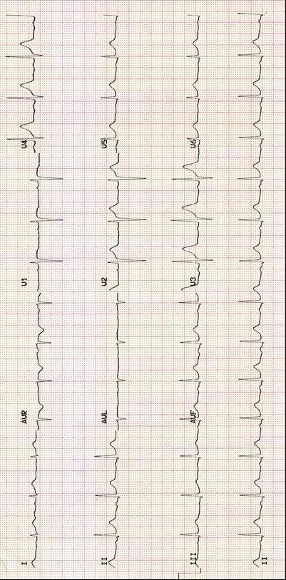 ECG normală. Ritm sinusal: unda P este prezentă, pozitivă în derivaţiile standard şi precede complexul QRS.