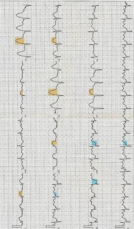 Infarct miocardic acut de perete anterior.