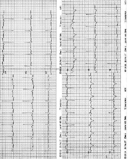 Infarct miocardic