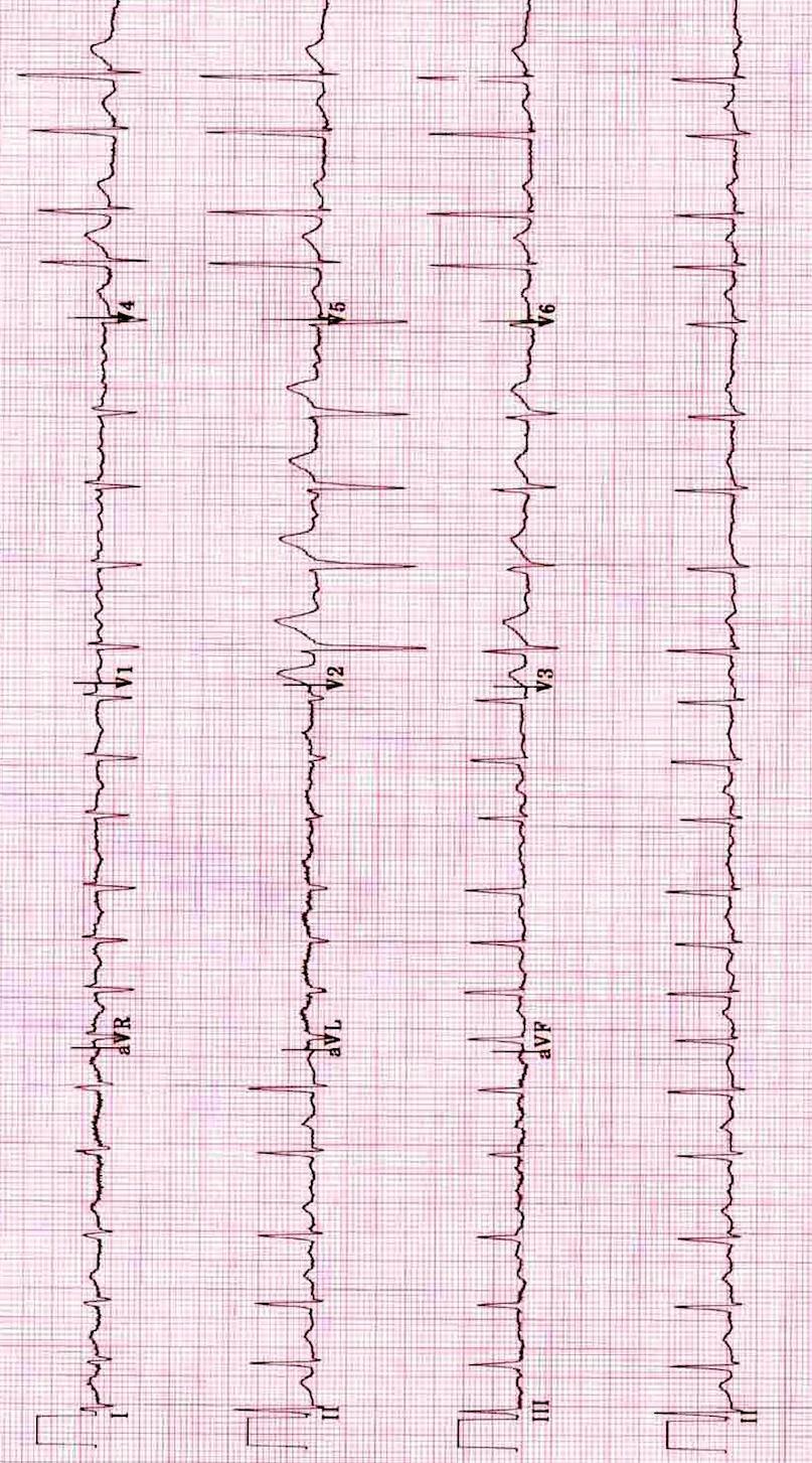Fibrilaţie atrială cu ritm ventricular rapid Frecvenţa cardiacă cca.