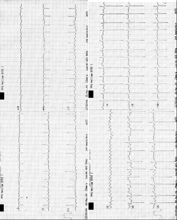 . Fibrilaţie atrială şi flutter atrial pe acelaşi traseu Distanţele R-R inegale în segmentele cu fibrilaţie, egale