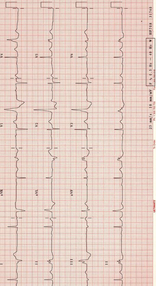 Extrasistole ventriculare de tip bigeminism.