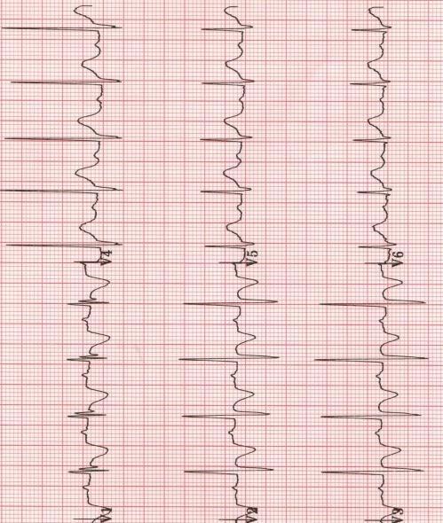 Traseu ECG normal la un copil de 2 ani.