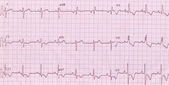 Hipertrofie atrială şi ventriculară dreaptă. Cord pulmonar cronic.