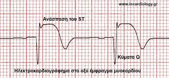 ΗΚΓ στο Οξύ