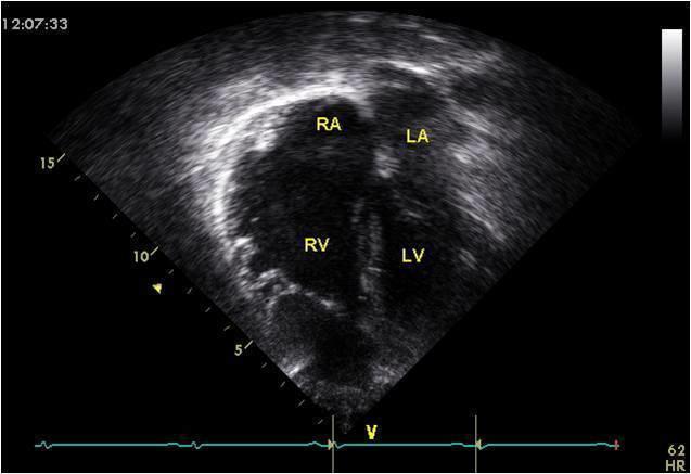 Right Atrium Left Atrium