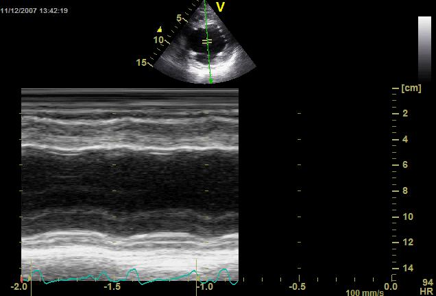 RESTING ECHO Thinned, highly