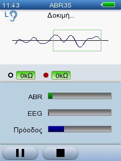 5 Δοκιμή με το AccuScreen 5.4.3 Η δοκιμή ABR Η δοκιμή εμφανίζεται στην οθόνη καθώς εξελίσσεται.