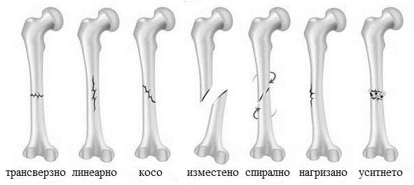 1. Биомеханика 30 Сл. 1.18: Седум карактеристични вида на фрактура на коска.