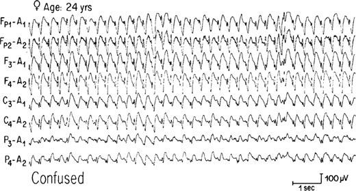 Τυπικό Αφαιρετικό SE Typical absence status epilepticus in idiopathic generalized epilepsy Cascino GD., Epilepsia 1993 Αφορά ασθενείς με ιδιοπαθή γενικευμένη επιληψία.