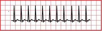 ΣΑΧΤΚΑΡΔΙΑ Στενό QRS (υπερκοιλιακι) Ευρφ QRS (κοιλιακι ι