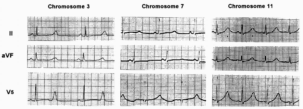 LQT syndrome