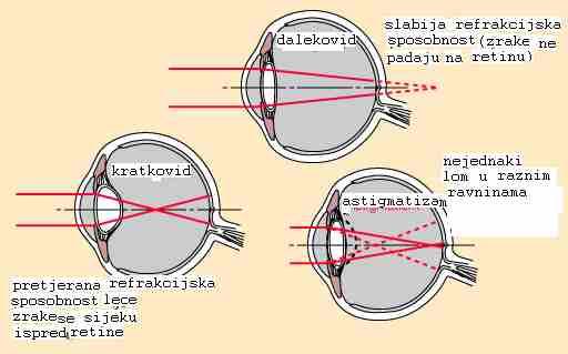 Mane oka su dalekovidnost leća oka nedovoljno skuplja zrake pa slika bližih predeta ne pada na retinu.kratkovidno oko pak previše loi zrake svjetlosti pa se daleki predeti ne vide jasno.