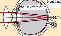 Ispred oka treba biti leća koja će sliku dalekog predeta ( x = ) dati u dalekoj točki oka.kako je to virtualna slika,ia, negativni predznak ( x = ).