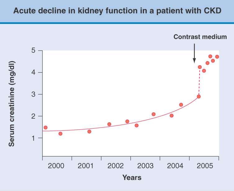 Εξέλιξη της XNN σε ασθενείς με ΣΔ Serum creatinine plot for a 58- year-old man with CKD secondary to diabetic nephropathy. An exponential increase over time is seen between 2000 and 2004.